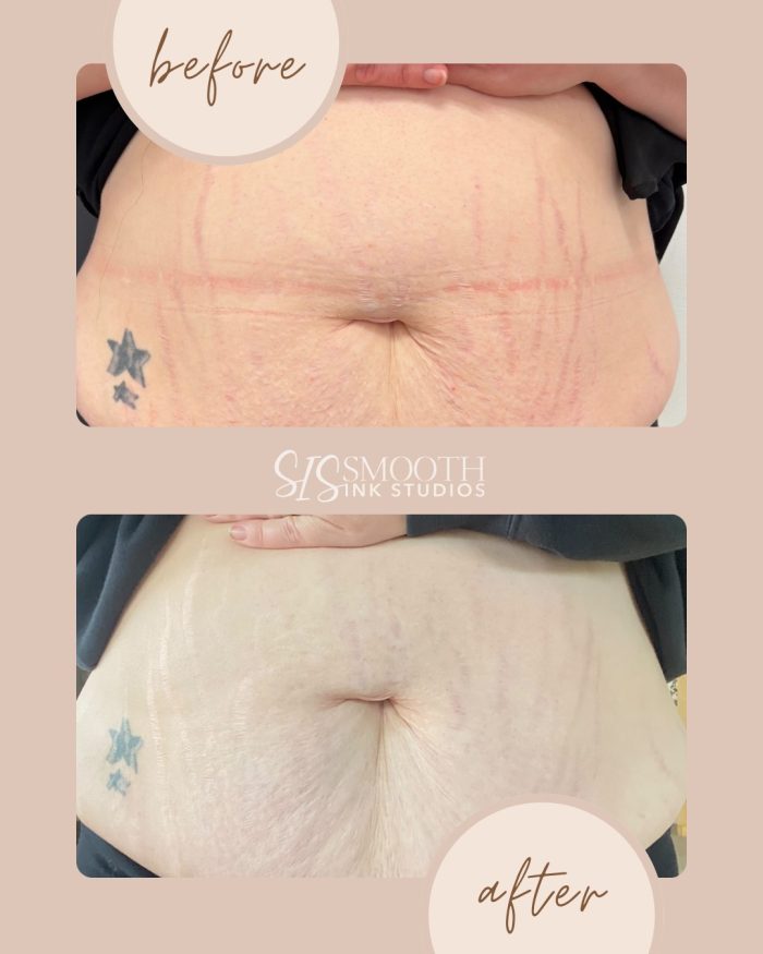 Treatment-ISR Before and After