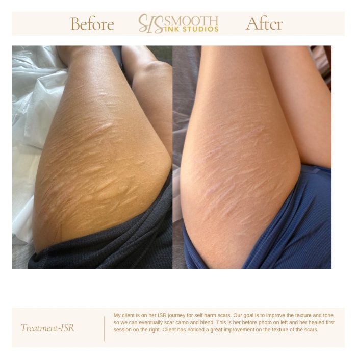 Treatment-ISR Neutral Before and After