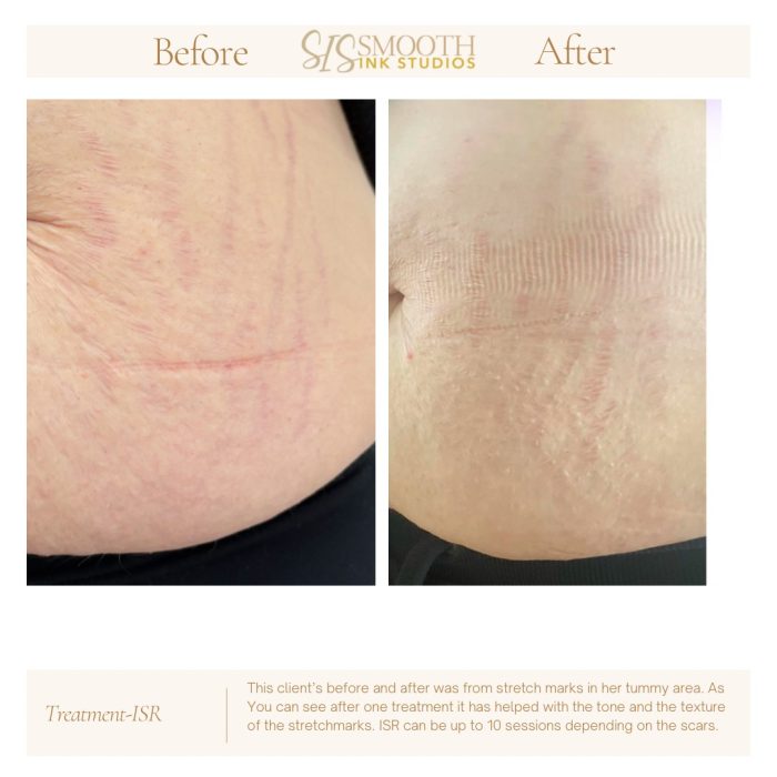 Treatment-ISR Neutral Before and After