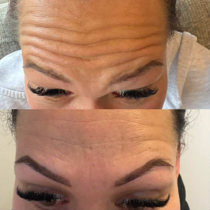 Inkless fine lines and wrinkles Before and After