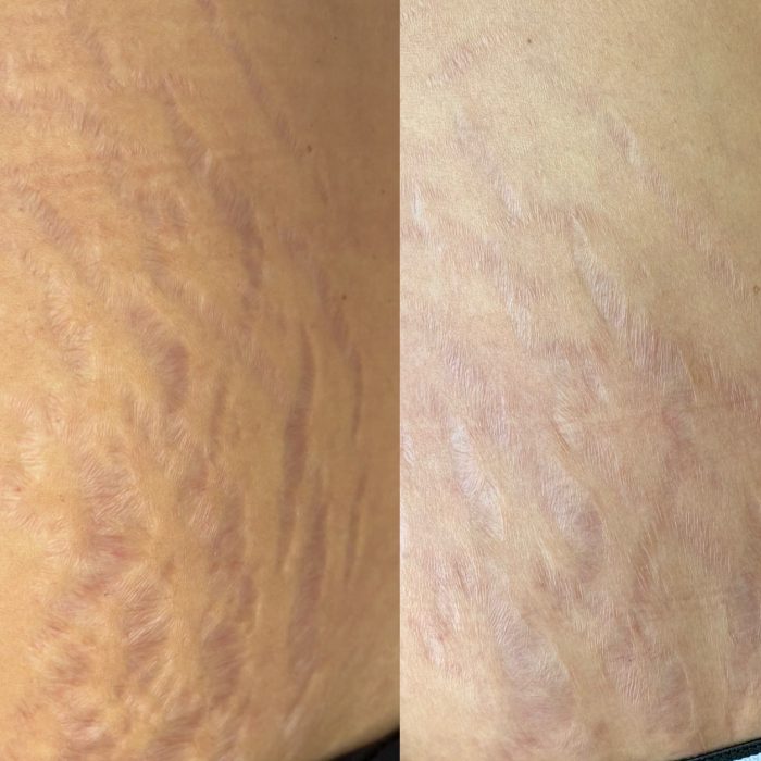 Treatment-ISR Before and After