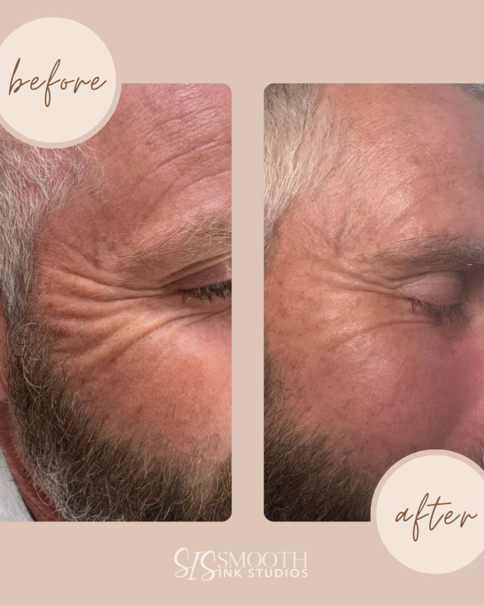 Inkless fine lines and wrinkles Before and After