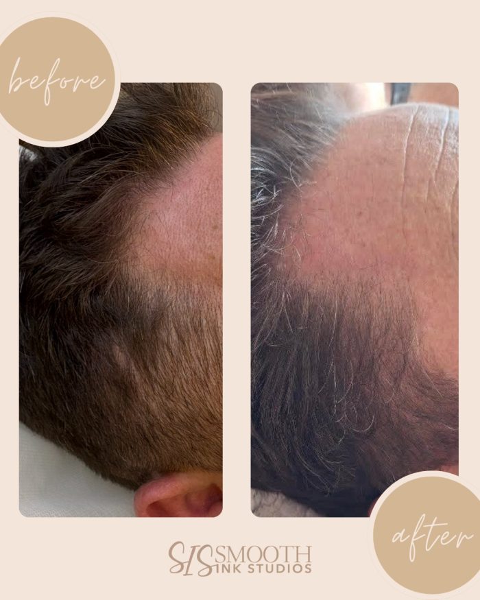 NUE STRAND Before and After