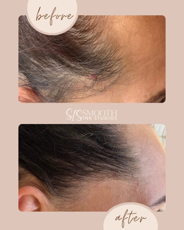 NUE STRAND Before and After