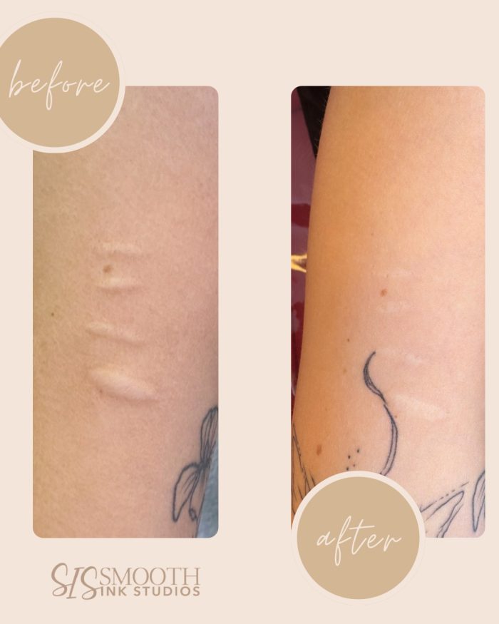 ISR Before and After