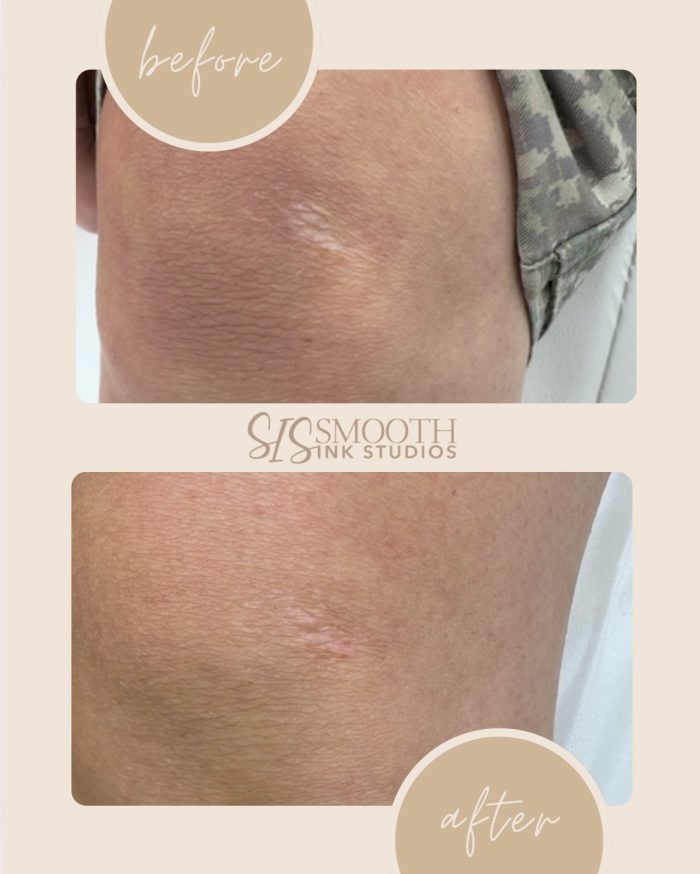 Neutral Before and After Neutral Before and After